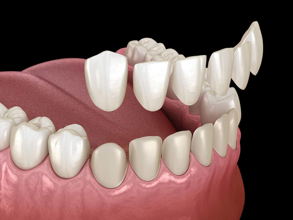 dental veneers graphic