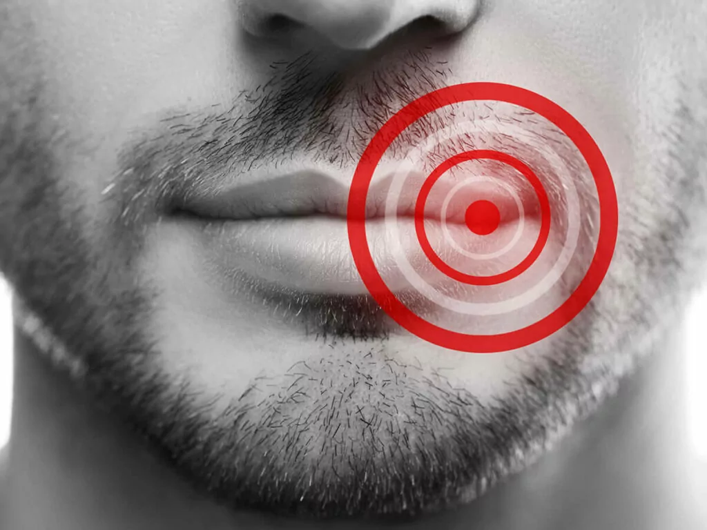 cold sore on lip